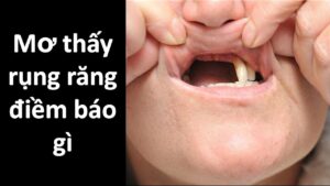 rụng răng 